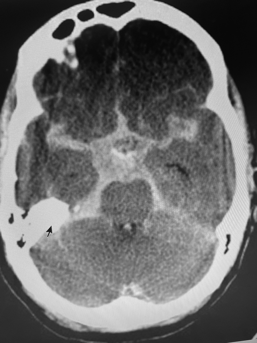 On CT scans, blood appears white. Depicted here is a subarachnoid hemorrhage (black arrow) on the right side of the brain from a different patient. There was no such obvious bleed in this tragic case.
