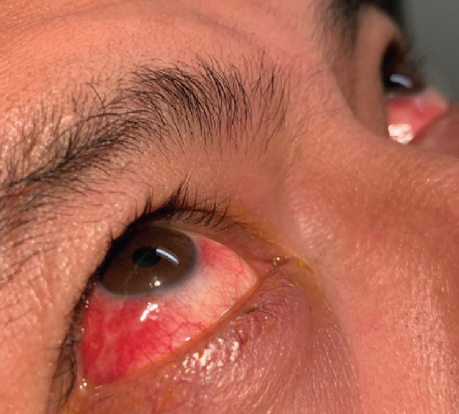Fig. 2. This case of red eye in a patient presenting for a problem-focused exam may require fuller analysis of review of systems and questioning about STI. 