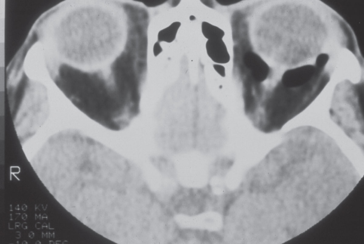 A CT scan of a patient with a left orbital floor fracture. While the fracture is not seen in this particular scan image, the air seen behind the left eye surrounding the optic nerve is consistent with communication between the orbit and the maxillary sinus.