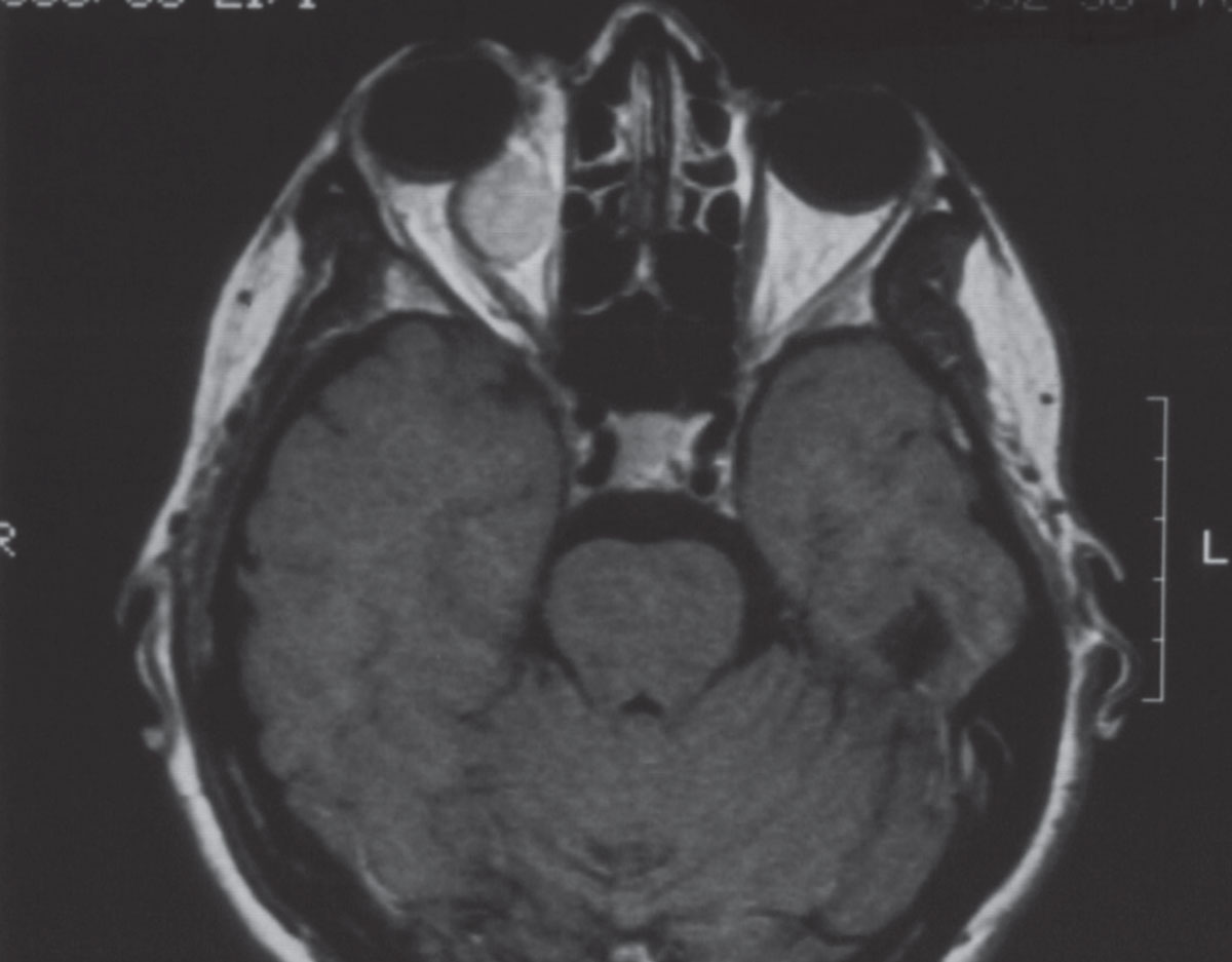 An axial MRI image demonstrating the presence of an enhancing mass in the right orbit. Note also the presence of proptosis seen on the right side as compared with the left.