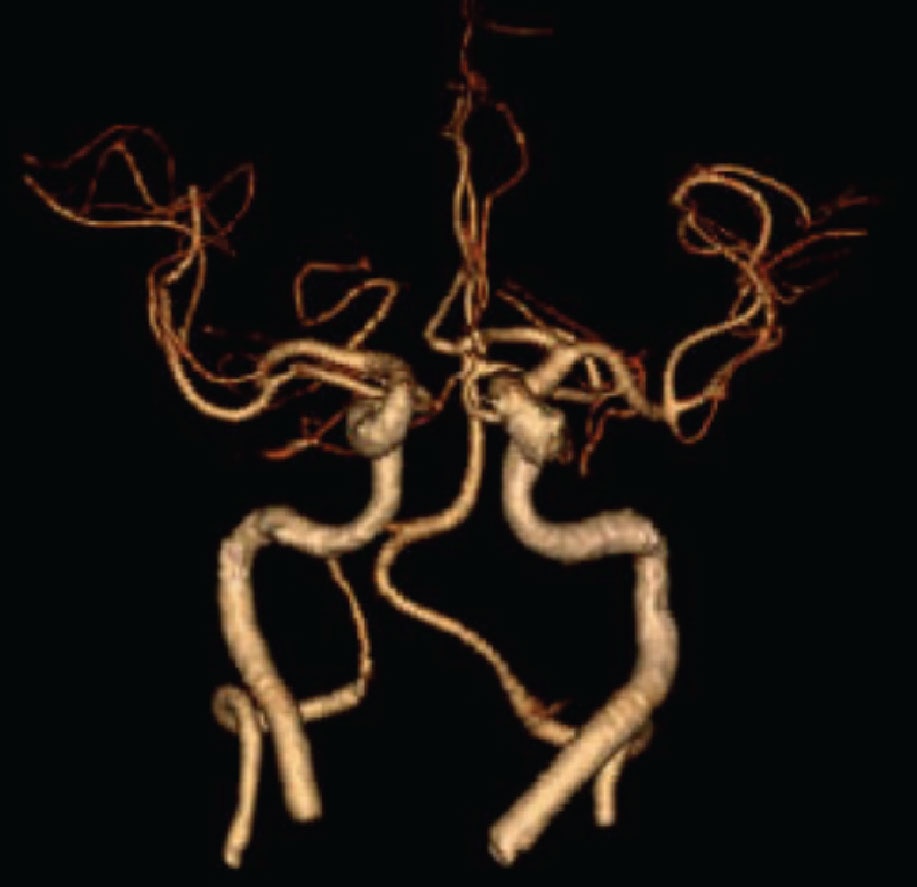 A CT angiogram of the neck and intracerebral arterial vasculature. In this antero-posterior view, one can clearly visualize the internal carotid arteries, the vertebral arteries, a portion of the circle of Willis and the anterior and middle cerebral arteries on both the right and left sides.