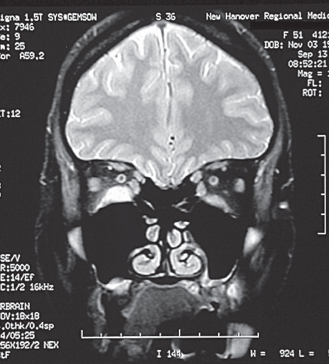 A coronal MRI of the orbits in a patient with Graves’ disease, demonstrating enlargement of the inferior recti muscles, right > left.