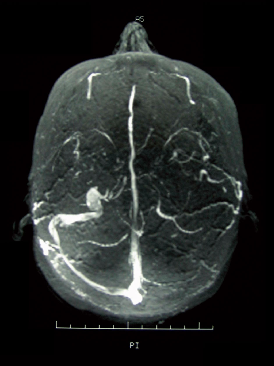 An MRV of a patient demonstrating stenosis of the left transverse sinus. MRV imaging is important in the workup of patients with papilledema, as abnormalities of the dural venous sinus system can affect CSF drainage and ultimately result in increased ICP.