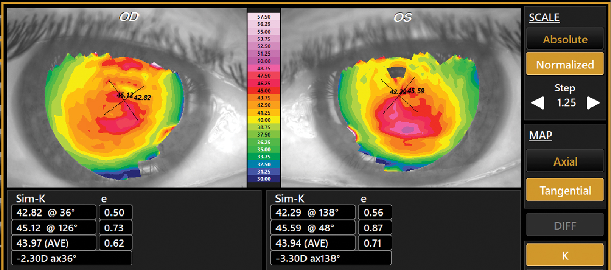 Fig. 2. Tangential topography of a 53-year-old male, which confirmed a first-time diagnosis of keratoconus. Best-spectacle corrected visual acuity was 20/20- in each eye with -0.50-2.00X038 OD and -0.50-2.50X137 OS. This was not “late onset” KCN but longstanding keratoconus that was not detected at any of his prior eye exams.