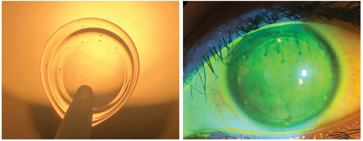 Fig. 4. Lens with registration marks at left. Same rotationally and translationally stabilized ultrahigh Dk soft lens on eye for wavefront-guided higher-order aberration correction for keratoconus.