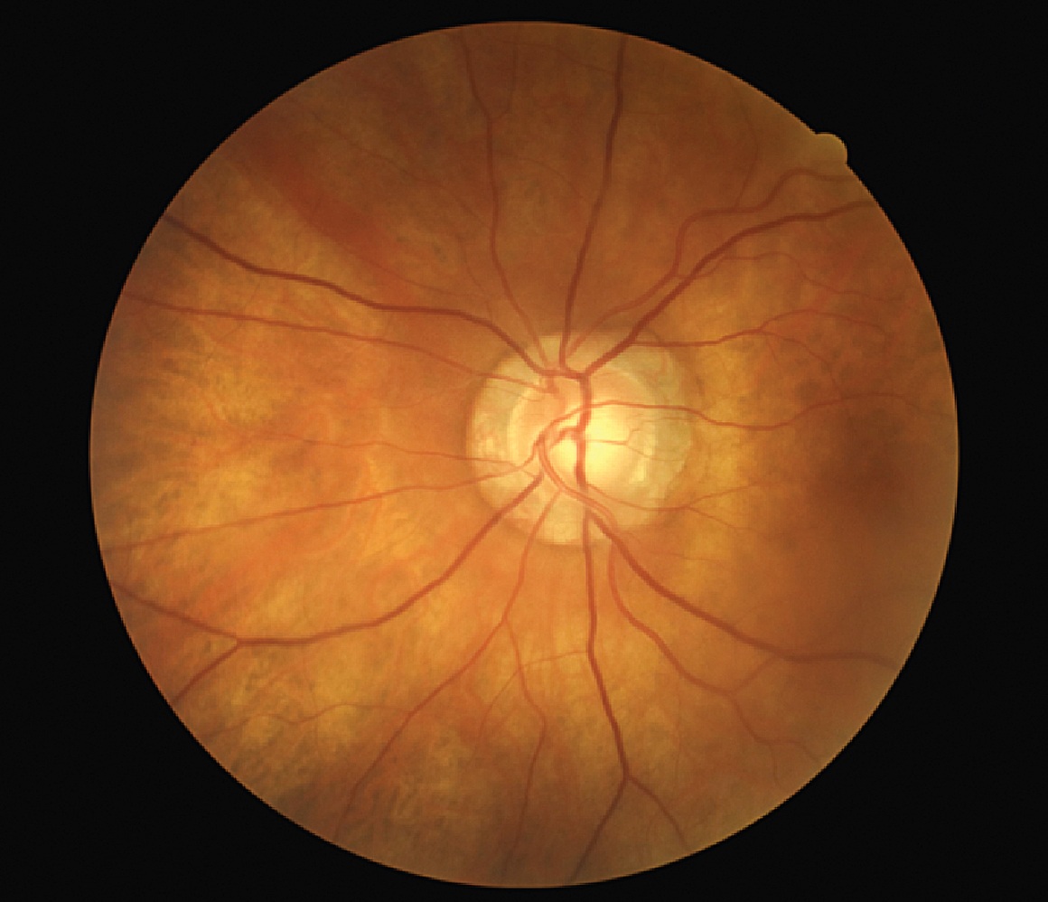 Optic nerve with neuroretinal rim loss could be diagnosed in a VA telehealth setting. 