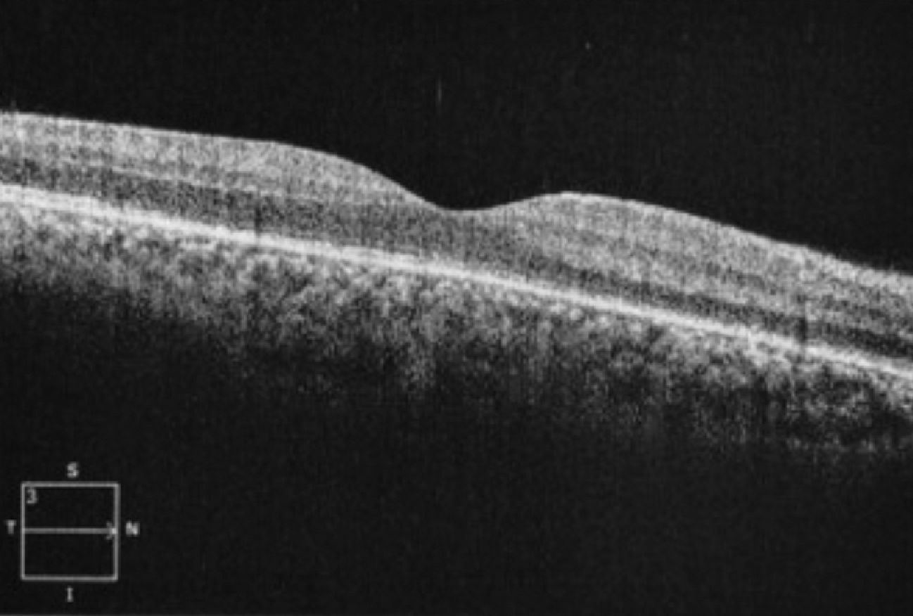 Fig. 1. OCT imaging with subtle areas of RPE thickening­, or placoid chorioretinitis.