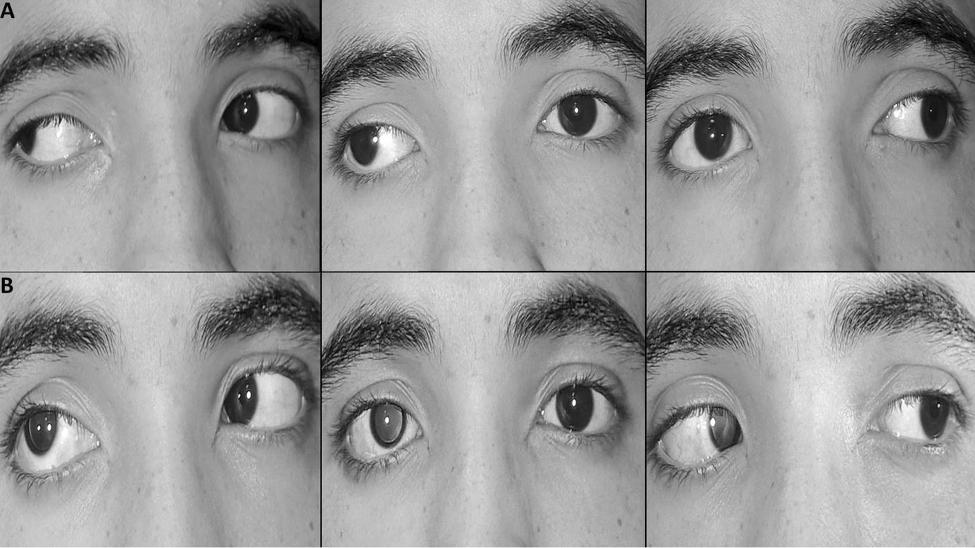Younger onset age, larger preoperative angle and less immediate postoperative overcorrection may increase the risk of early recurrence of intermittent exotropia.