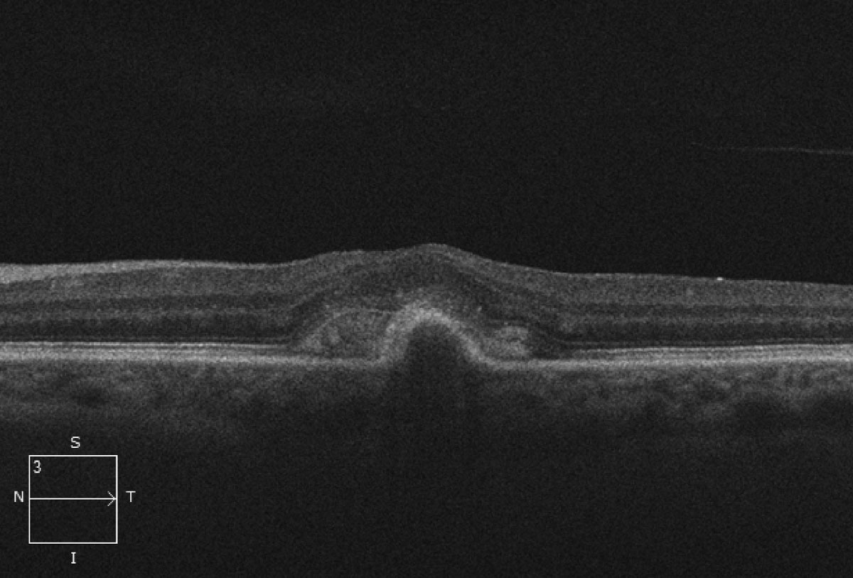 PED volume could predict the short- and long-term BCVA gains for non-PCV after intravitreal injection of conbercept.