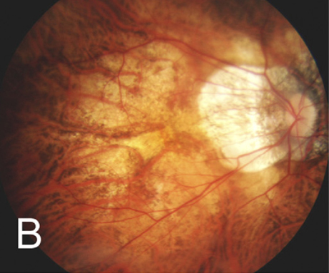 Diffuse chorioretinal atrophy seen in a 51-year-old, -21.00D myopic woman.