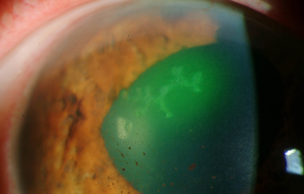 Immunodeficiency is shown to increase the odds of recurrent HSV keratitis.