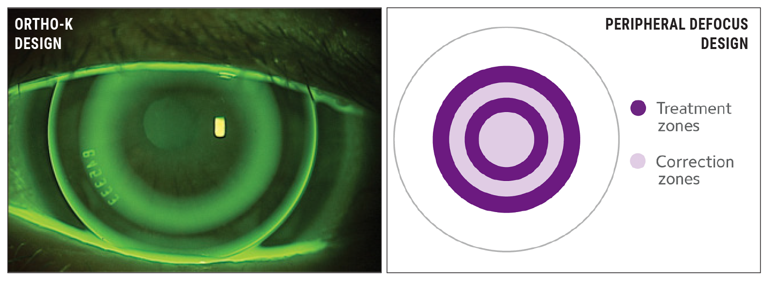 Ortho-K and multifocal lenses in children undergoing treatment match results from clinical trials. 