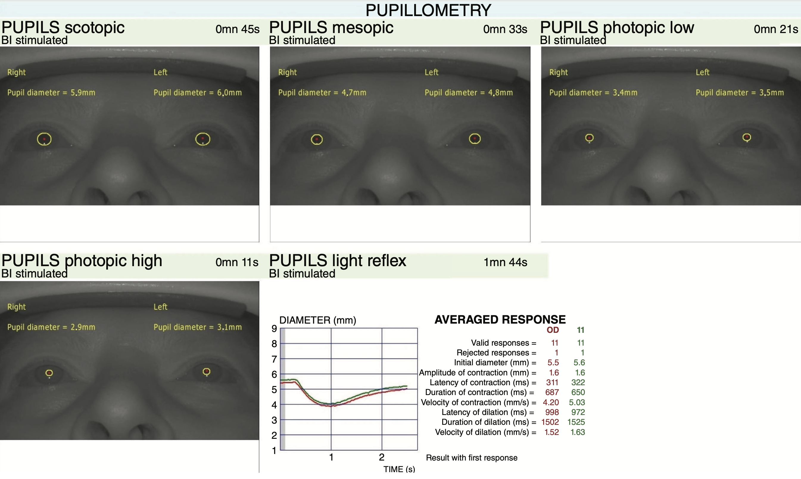 Automated pupillometry may prove a helpful diagnostic tool for early-stage glaucoma detection. 