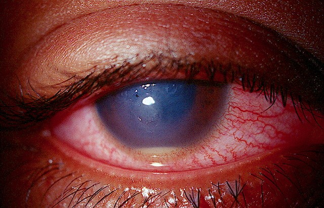 In cases of endophthalmitis following cataract surgery, poorer visual outcomes were seen in eyes with positive bacterial cultures and oral flora.