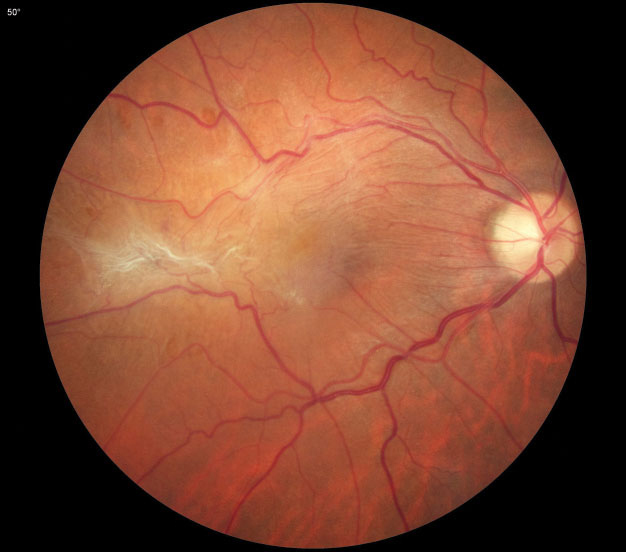 The presence and progression of pathological lesions in the macula, such as the ERM seen here, greatly affect patients’ visual function.