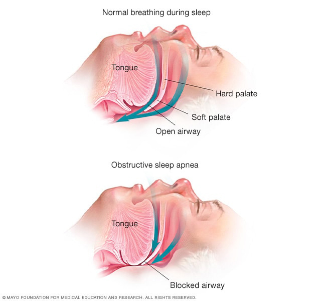 CPAP used for OSA treatment remains unclear in providing a positive or negative effect on glaucoma progression. 