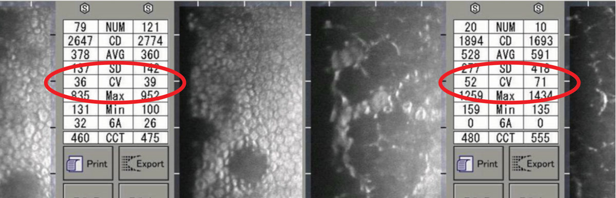 As CV value increases, the greater the variation seen in the size of endothelial cells. Both left and right photos show less uniform cells and greater CV values, accordingly.