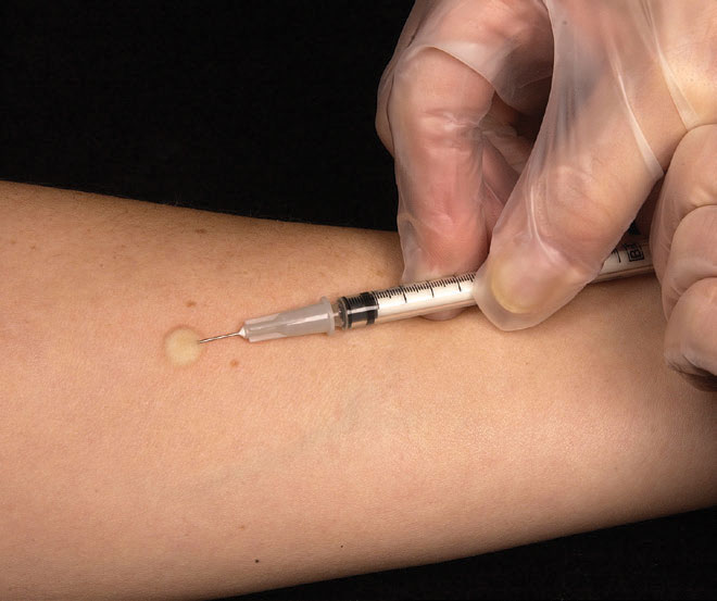 The TB skin test works by measuring a hypersensitivity reaction to the tuberculin protein, injected in the forearm.