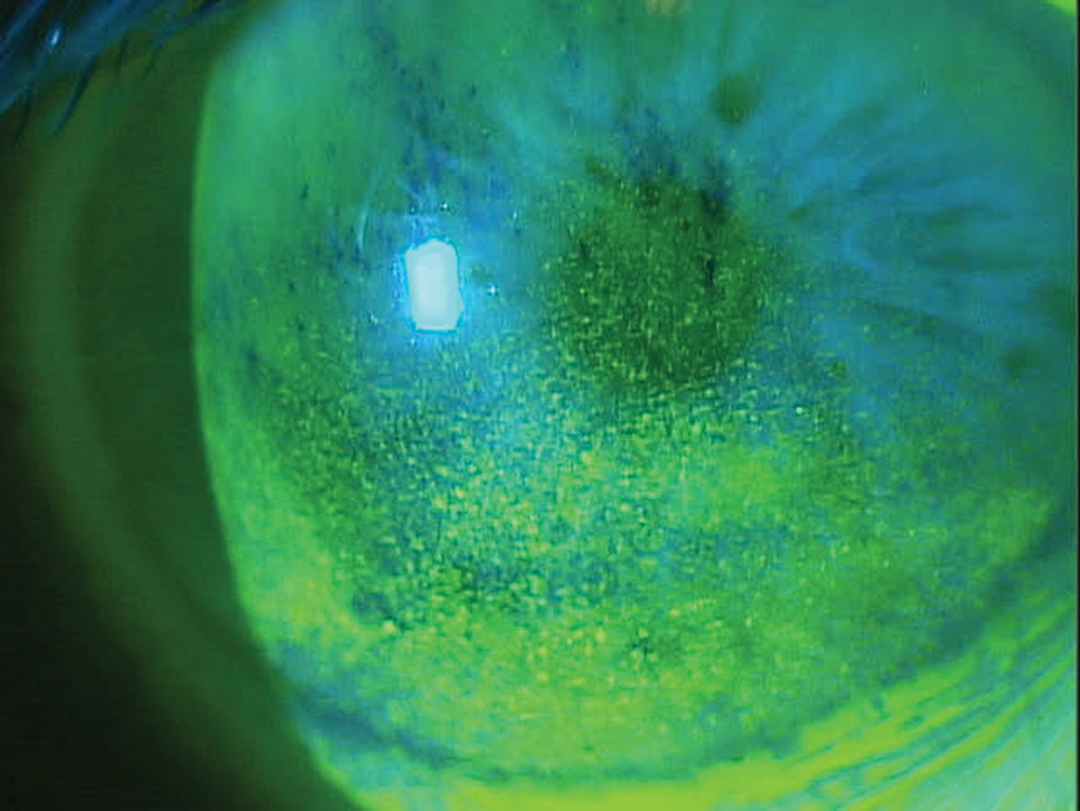 Corneal superficial punctate keratitis in a patient on multiple topical glaucoma medications.