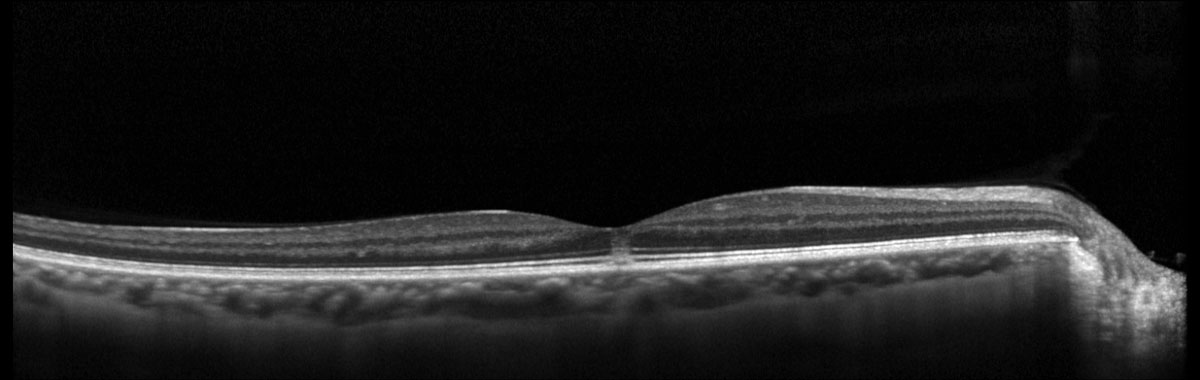 Fig. 1. Heidelberg Spectralis macular OCT of the right eye.