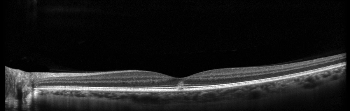 Fig. 2. Heidelberg Spectralis macular OCT of the left eye.