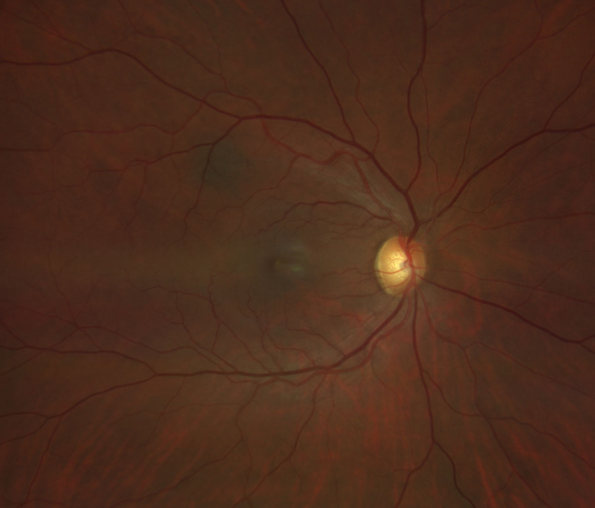 Fig. 3. Zeiss Clarus fundus photo of the right eye.