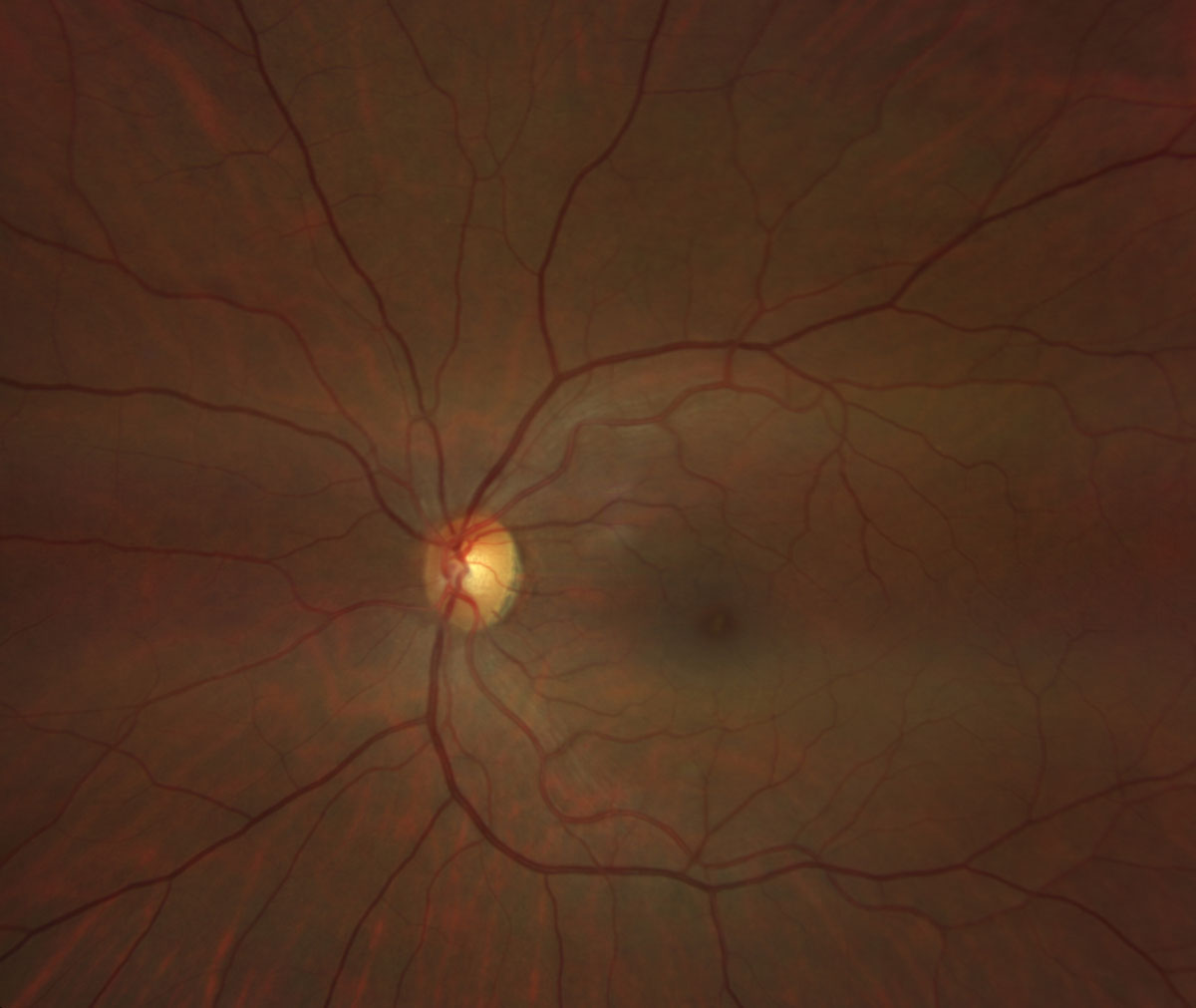 Fig. 4. Zeiss Clarus fundus photo of the left eye.