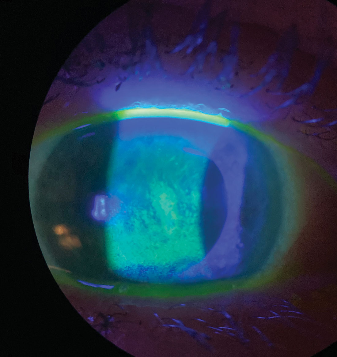 Sodium fluorescein staining shows this patient’s corneal surface is compromised by dry eye disease.