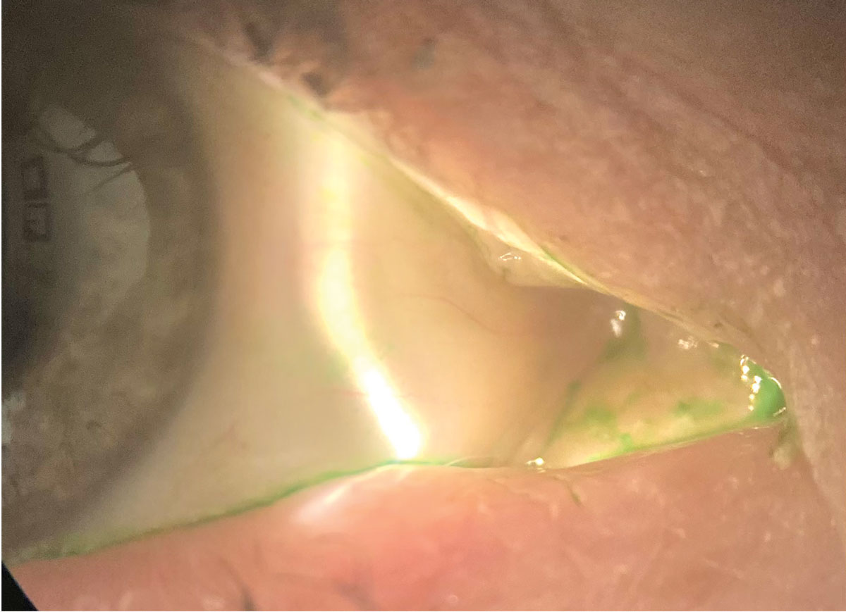Here, the conjunctiva is stained with lissamine green. Cequa showed a reduction in conjunctival staining in its clinical trials.