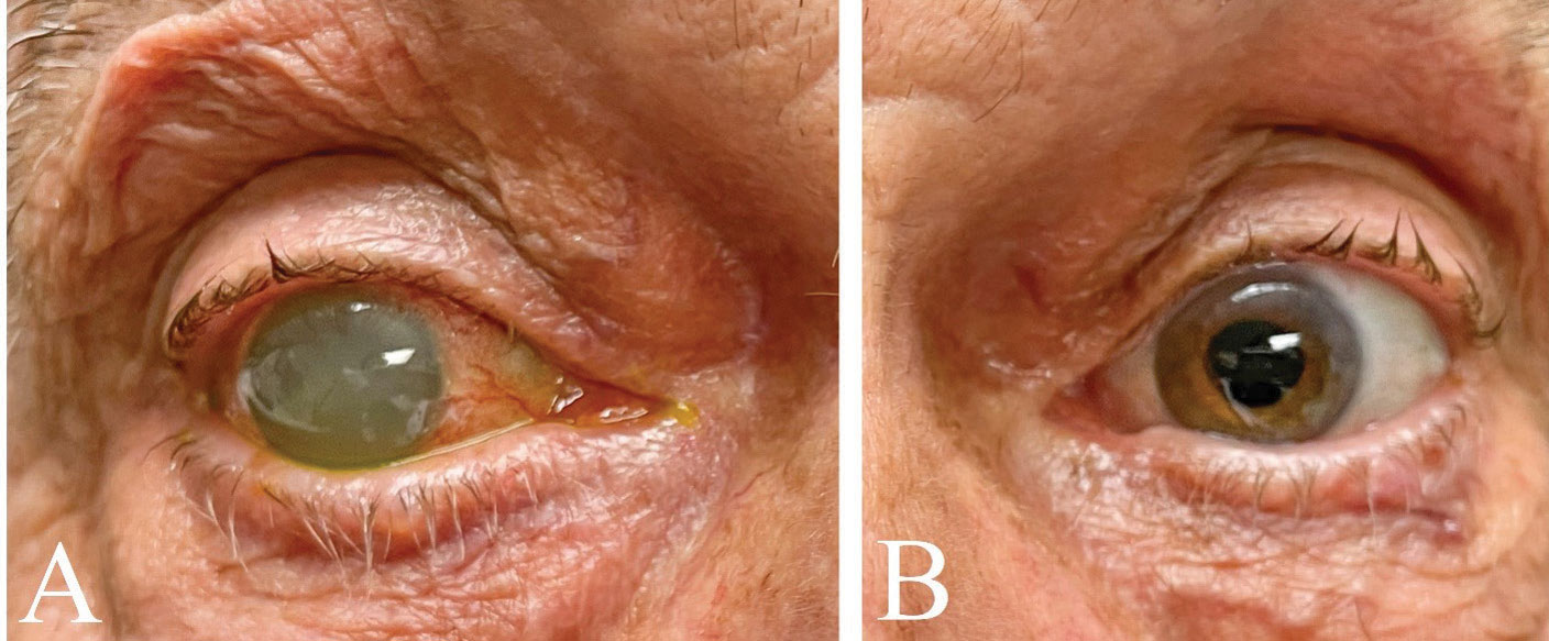 Fig. 1. The right (A) and left (B) eyes of this patient on presentation. Note the cloudiness apparent in the right eye’s anterior chamber. The left eye had previously undergone cataract extraction.