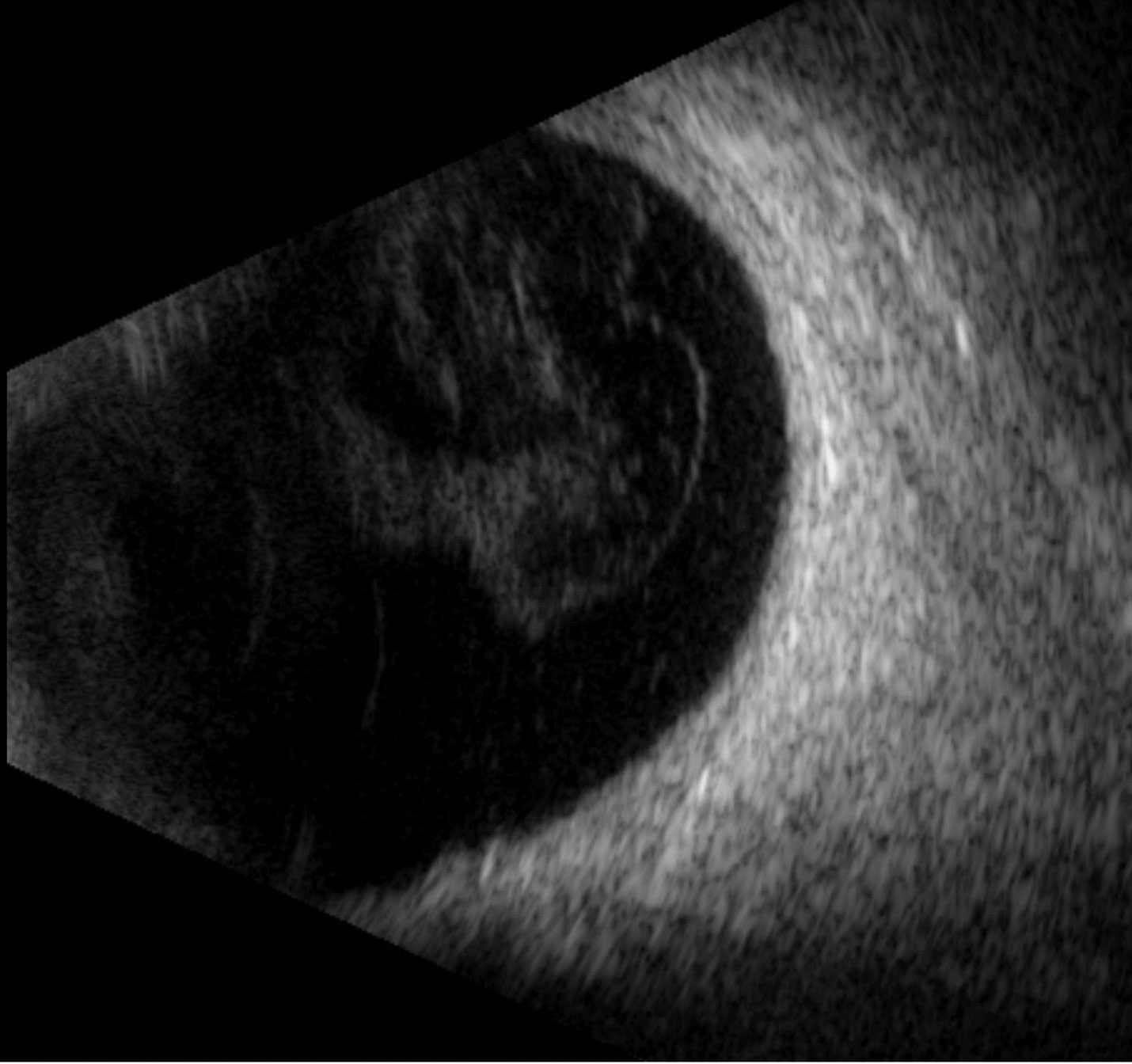 Fig. 3. A normal posterior segment exam with mild vitreous opacities but no retinal detachment or lesion.