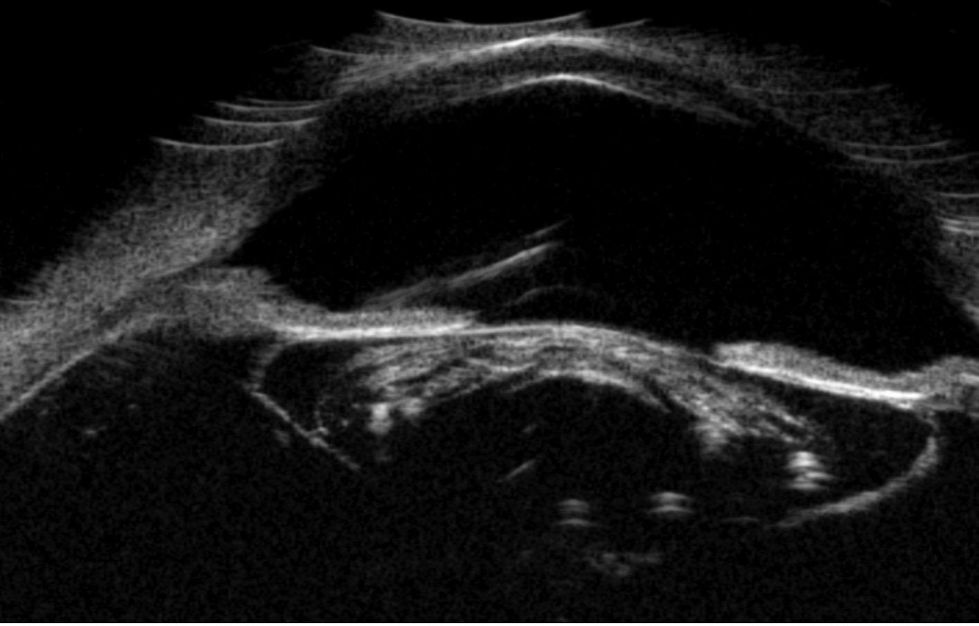 Fig. 4. A thickened mature lens with a very dense cortex causing posterior shadowing. Note the anterior chamber depth is preserved.