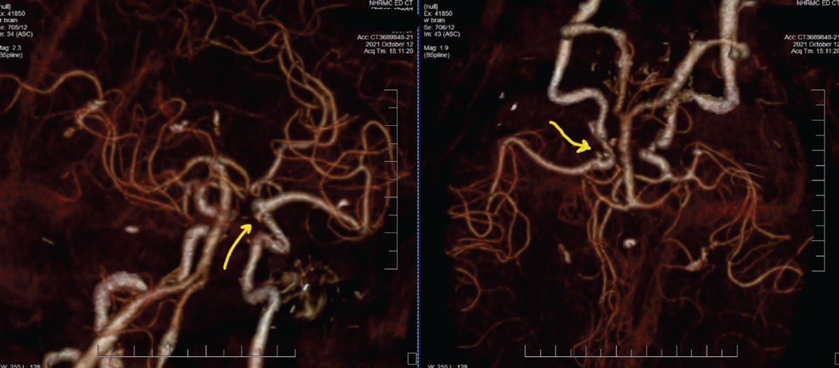 Fig. 5. These CTA images of the patient described show two different rotational views of the carotid, vertebral and basilar arteries, along with distributions of the anterior and middle cerebral arteries. The yellow arrows are directing to the aneurysm at the junction of the internal carotid artery and posterior communicating artery, which is the source of the third nerve palsy.