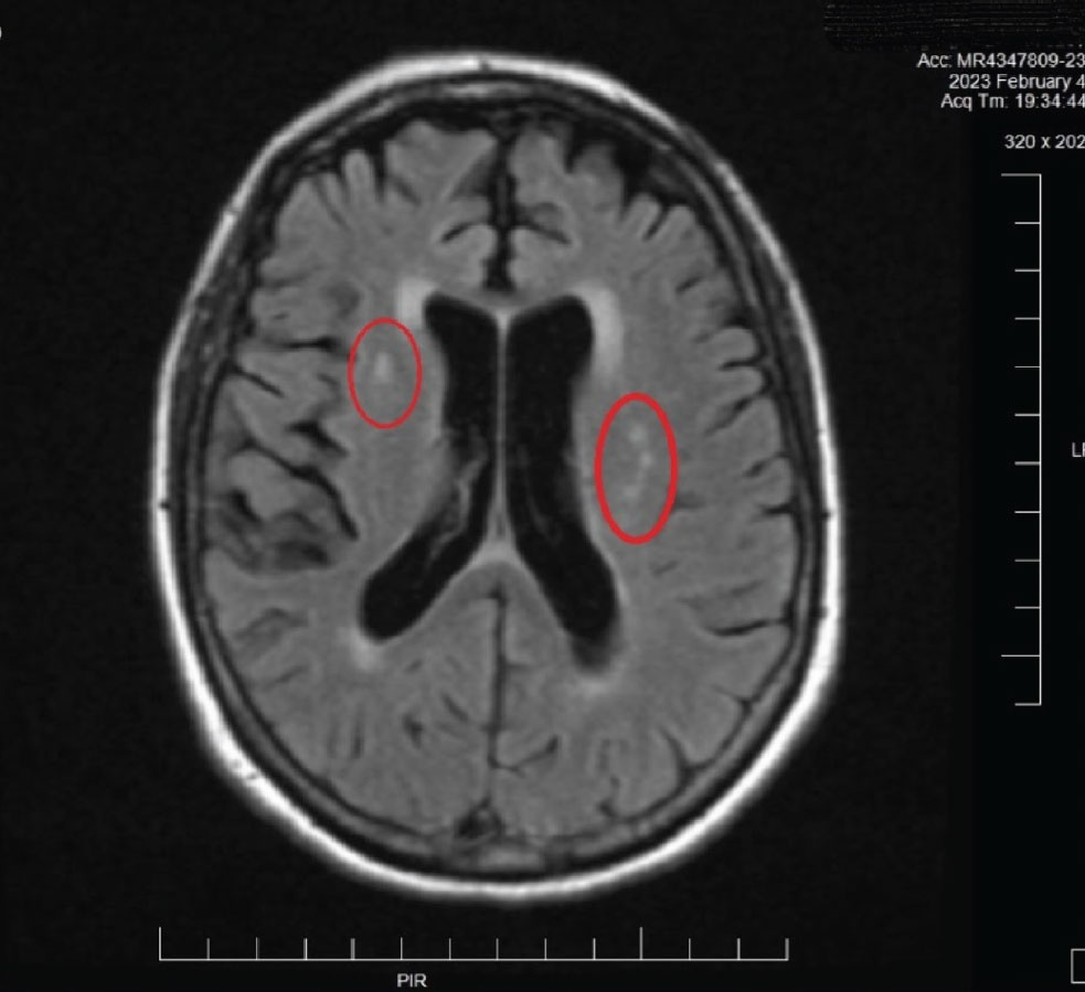 Fig. 8. This MRI image is from the patient described in Case 2. Note the hyperreflective areas in the periventricular white matter. These are consistent with age-related small vessel occlusive disease. Also note the fine brain parenchymal images obtained with MRI. This imaging method is preferred over CT imaging of the brain in many cases for this reason: resolution of fine detail of soft tissues.