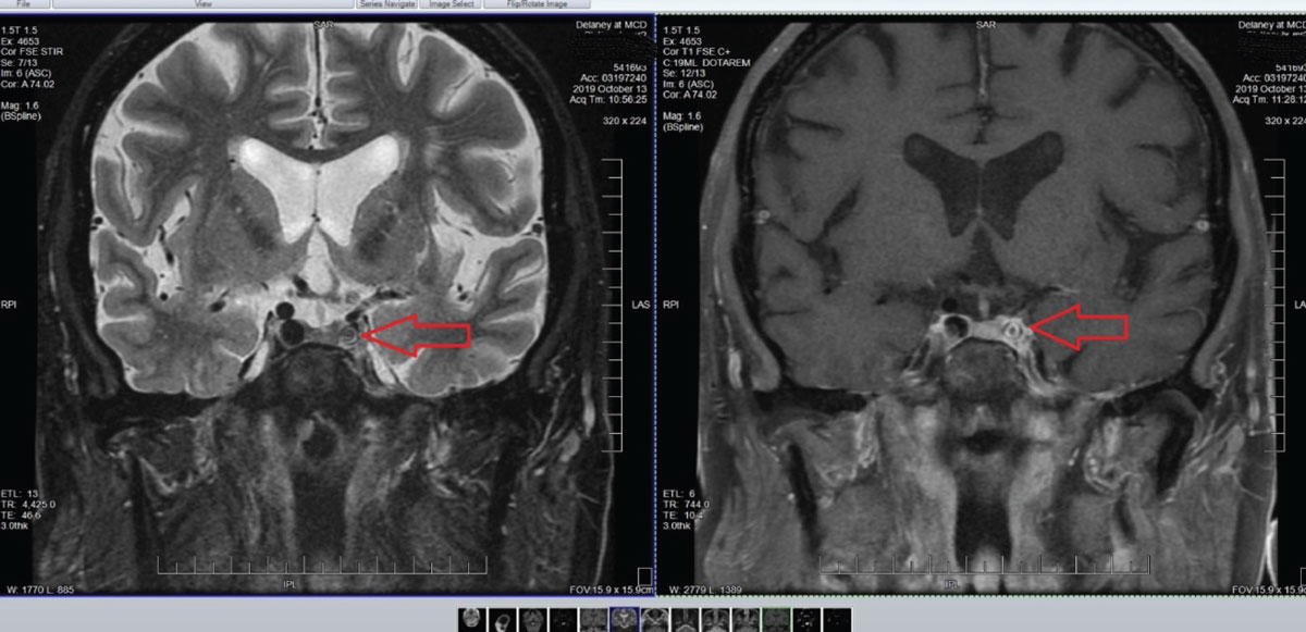 Fig. 9. Note in these images the marked stenosis of the internal carotid artery in the left cavernous sinus. Not surprisingly, other adjacent angiographic images demonstrated sclerosis of the middle and posterior cerebral arteries on the ipsilateral side and focal cerebral ischemia consistent with his chief complaint.
