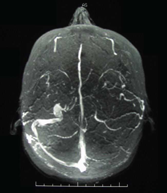 Fig. 10. An MRV image of transverse dural venous sinus stenosis in a patient with elevated intracranial pressure. The dural venous sinuses in MRV imaging are hyperintense; note the asymmetry of the transverse sinuses right vs. left.