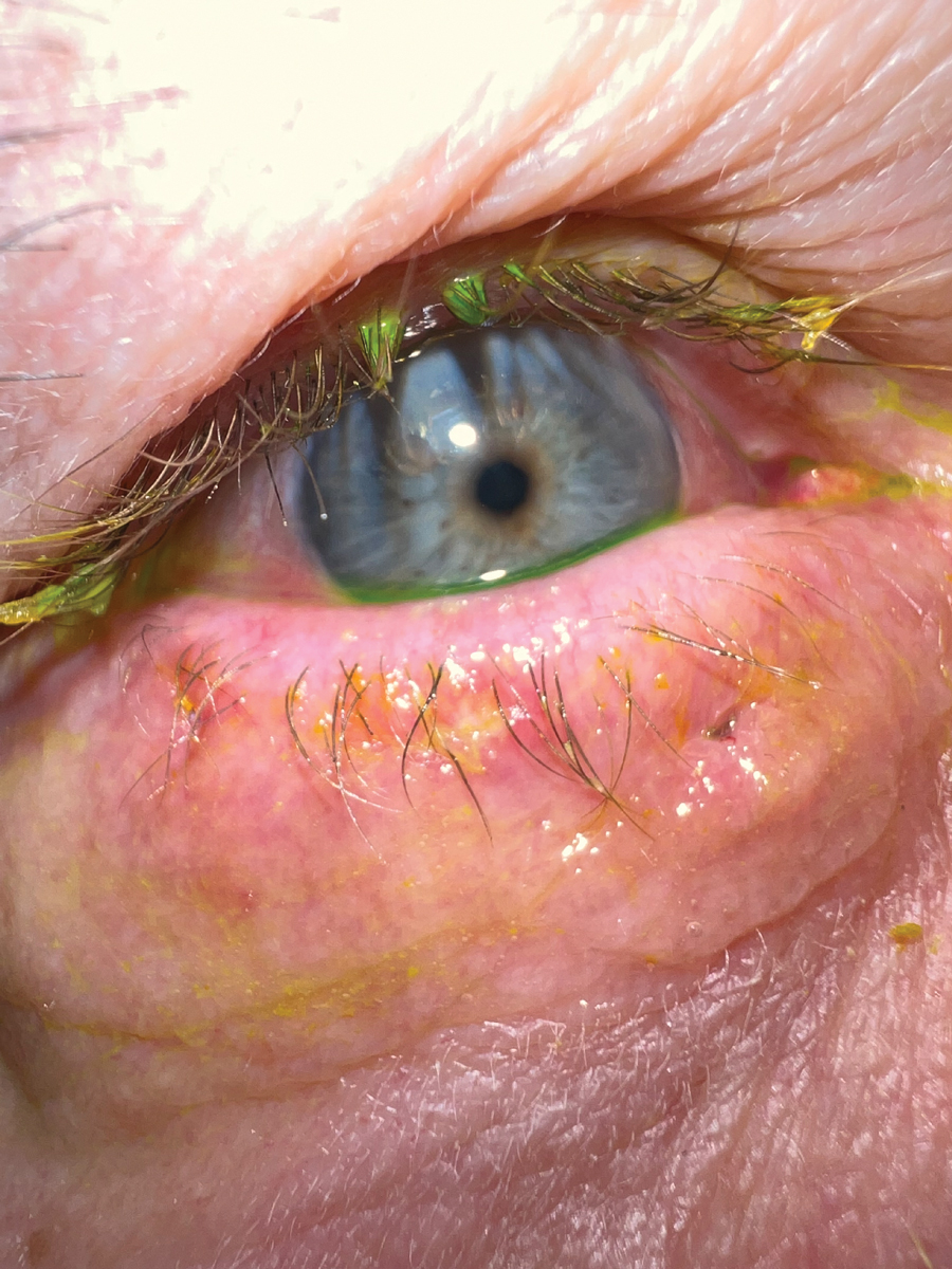 Fig. 6. The 10-day post-op visit. Note the perfect position of the eyelid margin.