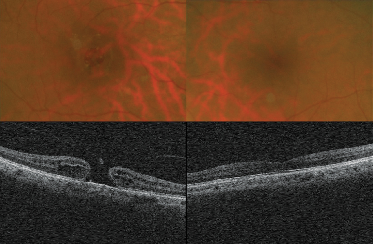 While the retinal findings above should be fairly clear, it is appropriate to consider whether or not the patient’s circumstances add additional complexity to the management of the case. Read the online discussion of this case for a thorough assessment of options.