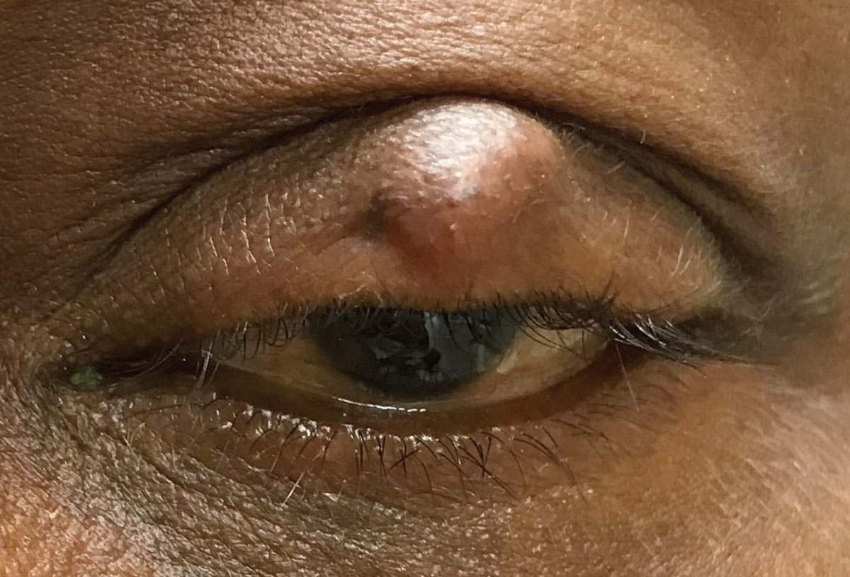 Non-Caucasian individuals were found to develop chalazion, and require surgical excision, more often than white patients.