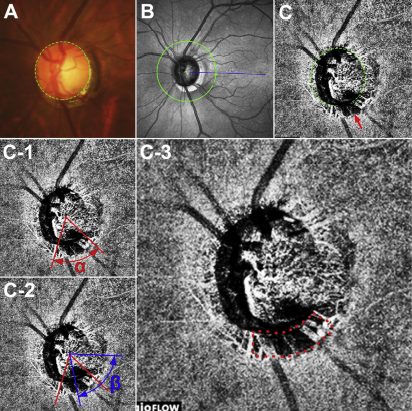 Clinically significant choroidal microvasculature dropout can be observed in areas without a β-zone, suggesting that it and this type of parapapillary atrophy may not necessarily share a common pathogenesis in eyes with POAG.