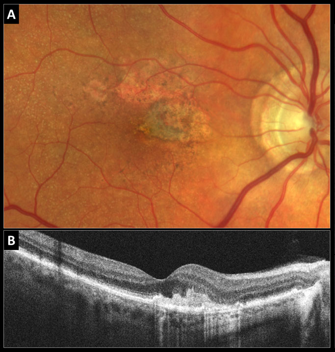 Inactive type 2 neovascular AMD: (A) Color photo shows the gray-green subretinal fibrovascular complex in the nasal fovea with adjacent RPE atrophy and reticular pseudodrusen. (B) Structural OCT reveals a subretinal hyperreflective fibrovascular complex and no fluid.