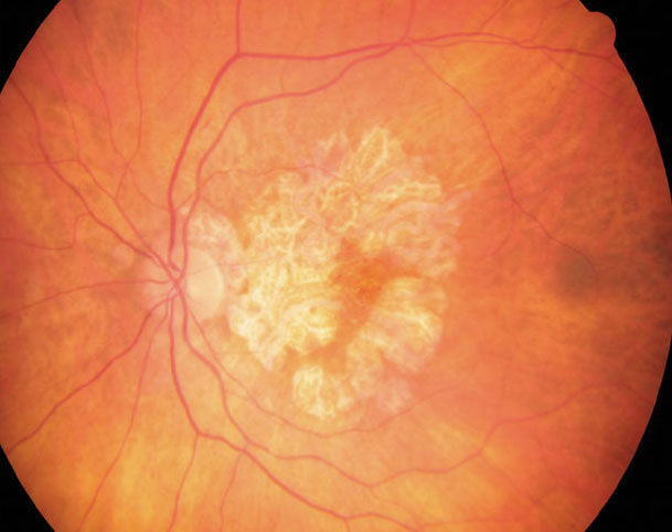 Future therapies targeting the gene ARMS2/HTRA1 may be effective in treating AMD disease by decreasing GA development and slowing its expansion.