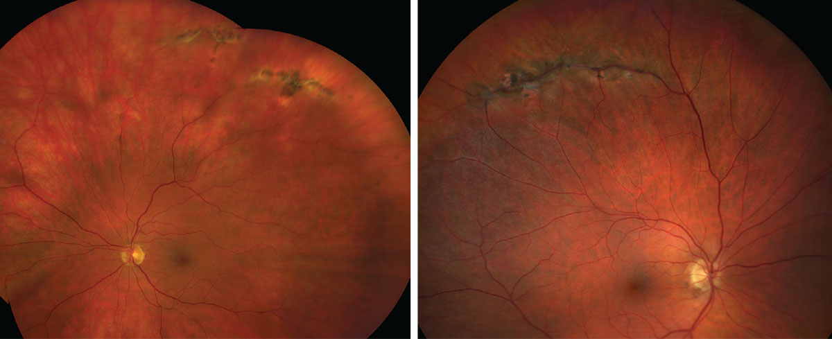 Patients who are more likely to develop retinal detachment or retinal tear after cataract surgery include those with male gender, younger age, lattice degeneration (pictured), hypermature cataract, posterior vitreous detachment and high myopia, study finds.