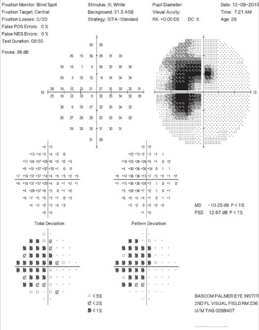 Patients with both myopia and glaucoma are at a greater risk for progressively declining vision loss than patients with only glaucoma, particularly in regions surrounding the central visual field.