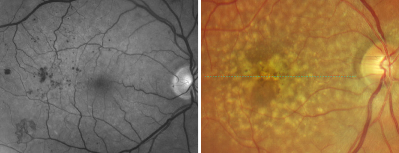 Milder DR at baseline was associated with increased risk of AMD.