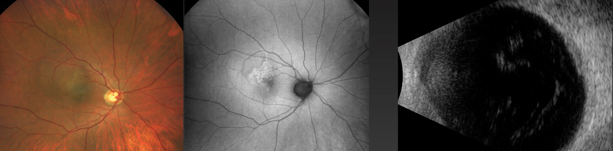 A comparison of fundus imaging (left), autofluorescence (middle) and ultrasound (right) for the same case as the previous image. The ultrasound B-scan appears to be the most sensitive to detect this relatively flat melanoma.