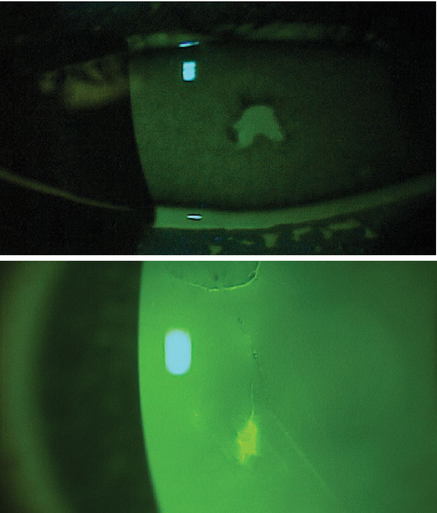 Fig. 1. Corneal abrasions stained with fluorescein and visualized using a cobalt blue light.