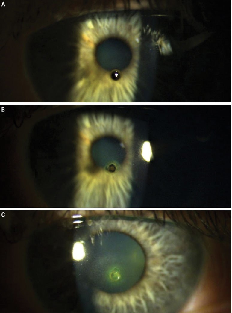 Fig. 2. (A) Metallic foreign body with early rust proliferation embedded in the central cornea. (B) Remaining metallic foreign body after the superficial metal was removed with a foreign body spud. (C) Corneal abrasion with sodium fluorescein uptake remaining after removal of a metallic foreign body.