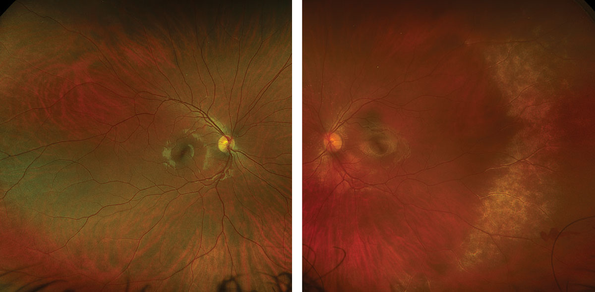 Figs. 1 and 2. Optos ultra-widefield fundus photo of the right eye (left) and left eye (right).