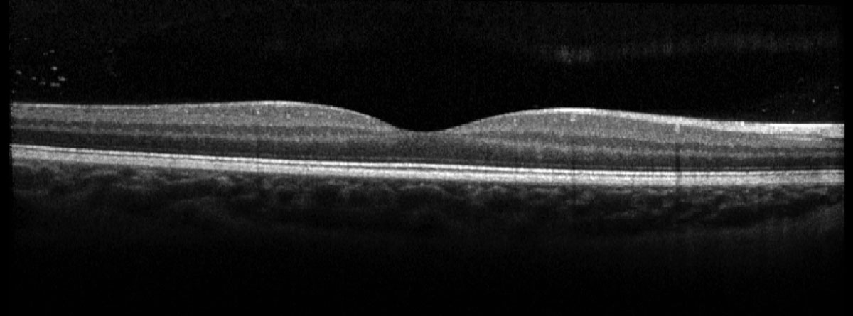 Fig. 3. Heidelberg OCT of the right macula.